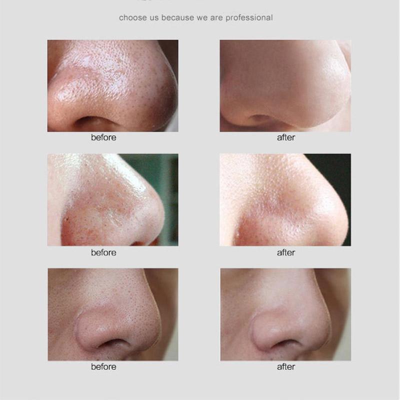 Electric Home Powerful Blackhead Remover Facial Beauty Device Acne Microcrystalline Blackhead Cleansing Device Shrink Facial Pores