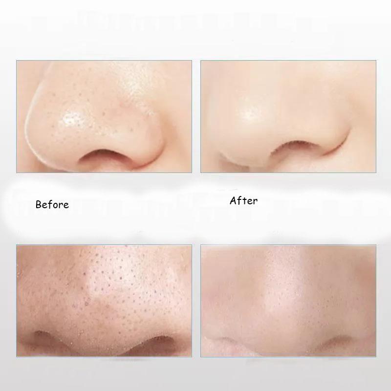 Blackhead Suction Artifact Electric Acne Facial Cleansing Device Beauty Suction Equipment To Remove Pores Cleaner Face Washing