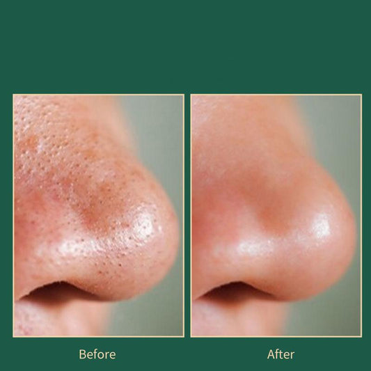Blackheads Suction Artifact Electric Suction To Remove Pores and Acne Cleansing Small Suction Bubbles Facial Cleansing Beauty Equipment