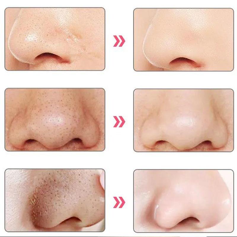 Blackhead Acne Artifact Pores and Stains Suction Device Pore Cleansing Facial Instrument Household Small Bubble Beauty Instrument