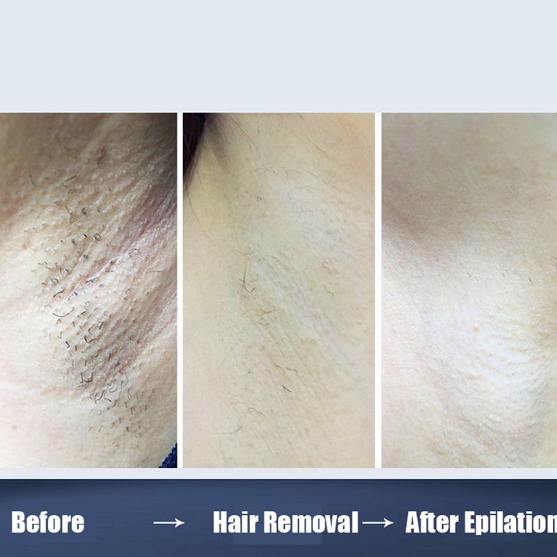 Hair Removal Instrument Permanent Student Laser Lady Long Term Hair Remove Device Electric Shavers