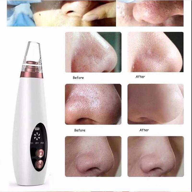 Blackheads Artifact Suction Blackheads Acne Instrument Facial Cleansing Beauty Instrument Small Bubbles Blackheads Shrink Pores Tool