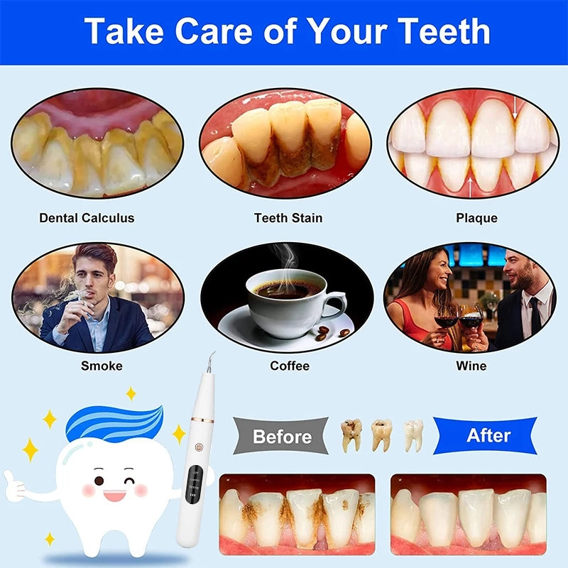 Electric tooth scaler Ultrasonic calculus remover Oral plaque and tartar scaler Teeth whitening tool