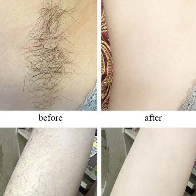 Epilator Permanent Face Lip Underarm Hair Private Parts Laser Freezing Point Hair Removal Instrument