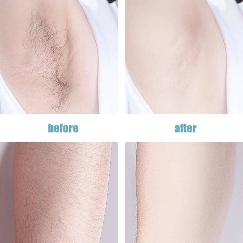 Laser Hair Removal Instrument Freezing Point Hair Remove Home Artifact Armpit Lip Hair Whole Body