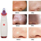 Blackheads Artifact Electric Powerful Suction Blackheads Acne Beauty Equipment To Clean The Student's Face Shrink Pores