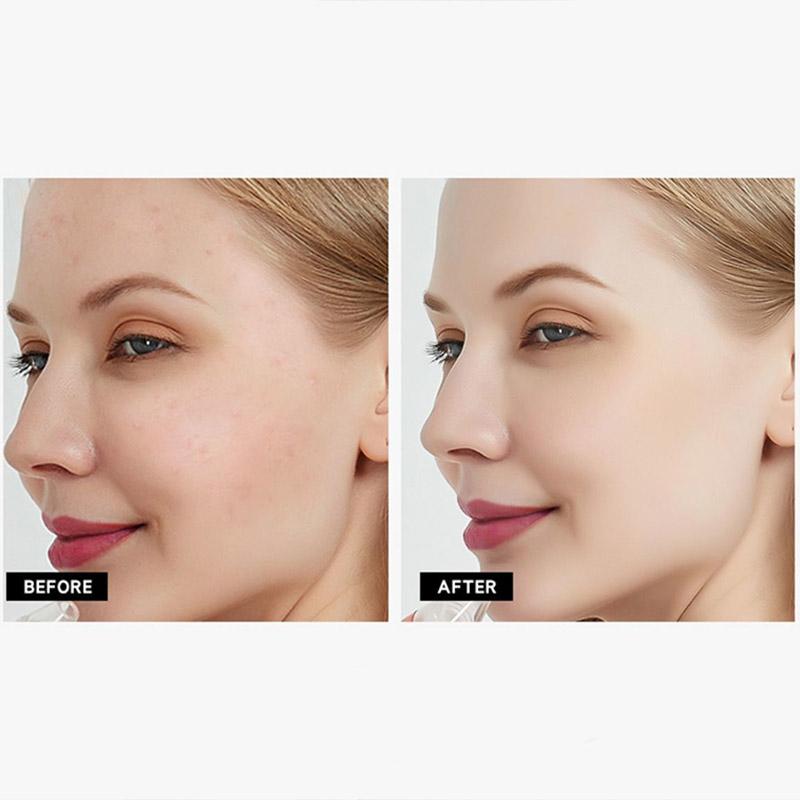 Blackheads Suction Artifact Electric Suction To Remove Blackheads and Acne From The Nose Pore Cleansing Facial Beauty Instrument