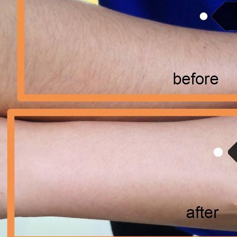 Laser Hair Removal Instrument Photon Private Freezing Point Lip Hair Artifact Female Armpit Leg Hair